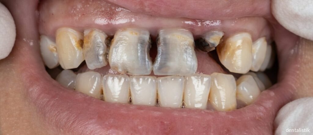Black decay visible on upper front teeth showing signs of dental caries